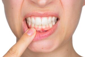 Periodoncia