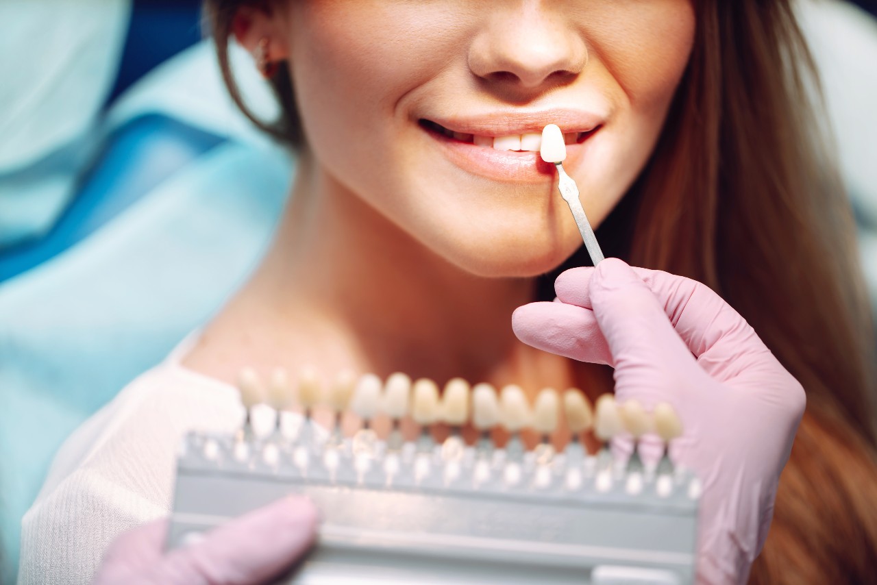 Descubriendo el Mundo de las Carillas Dentales