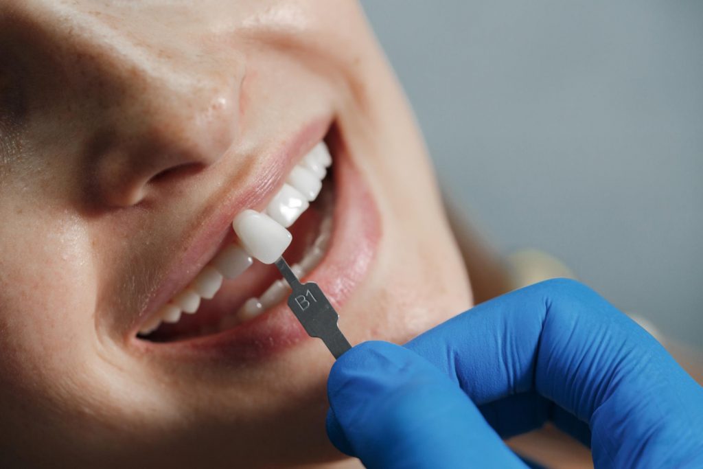 Carilla dental