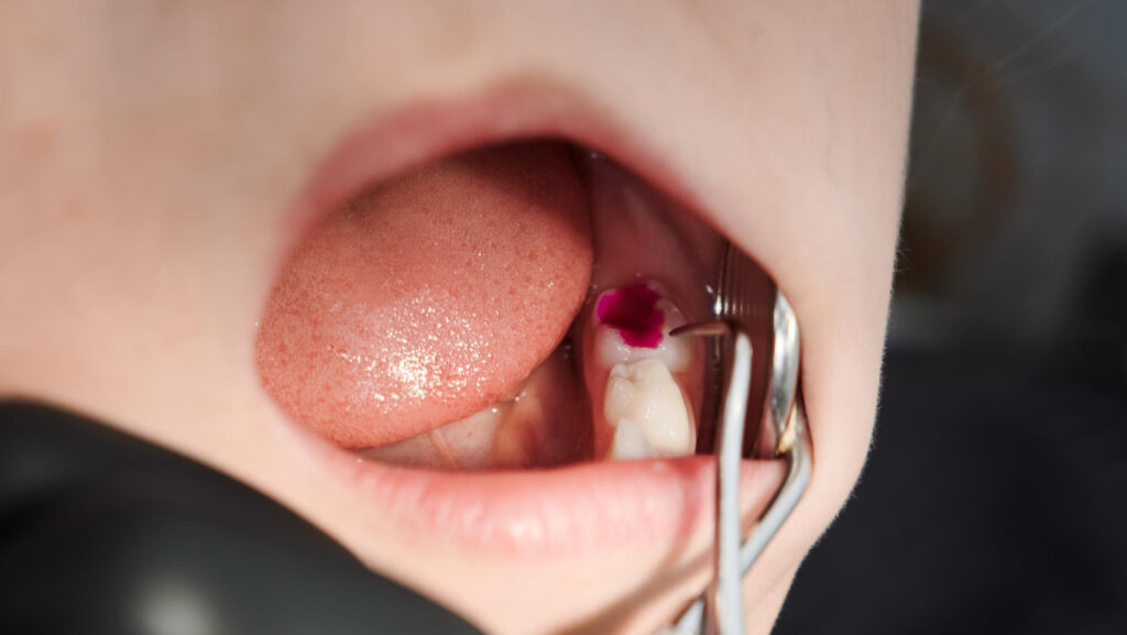 Incrustación dental