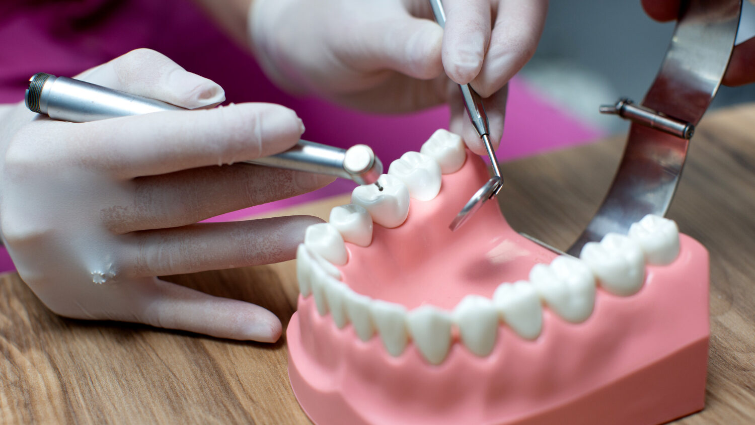 Incrustaciones Dentales: La solución para Restaurar tu sonrisa en Chile