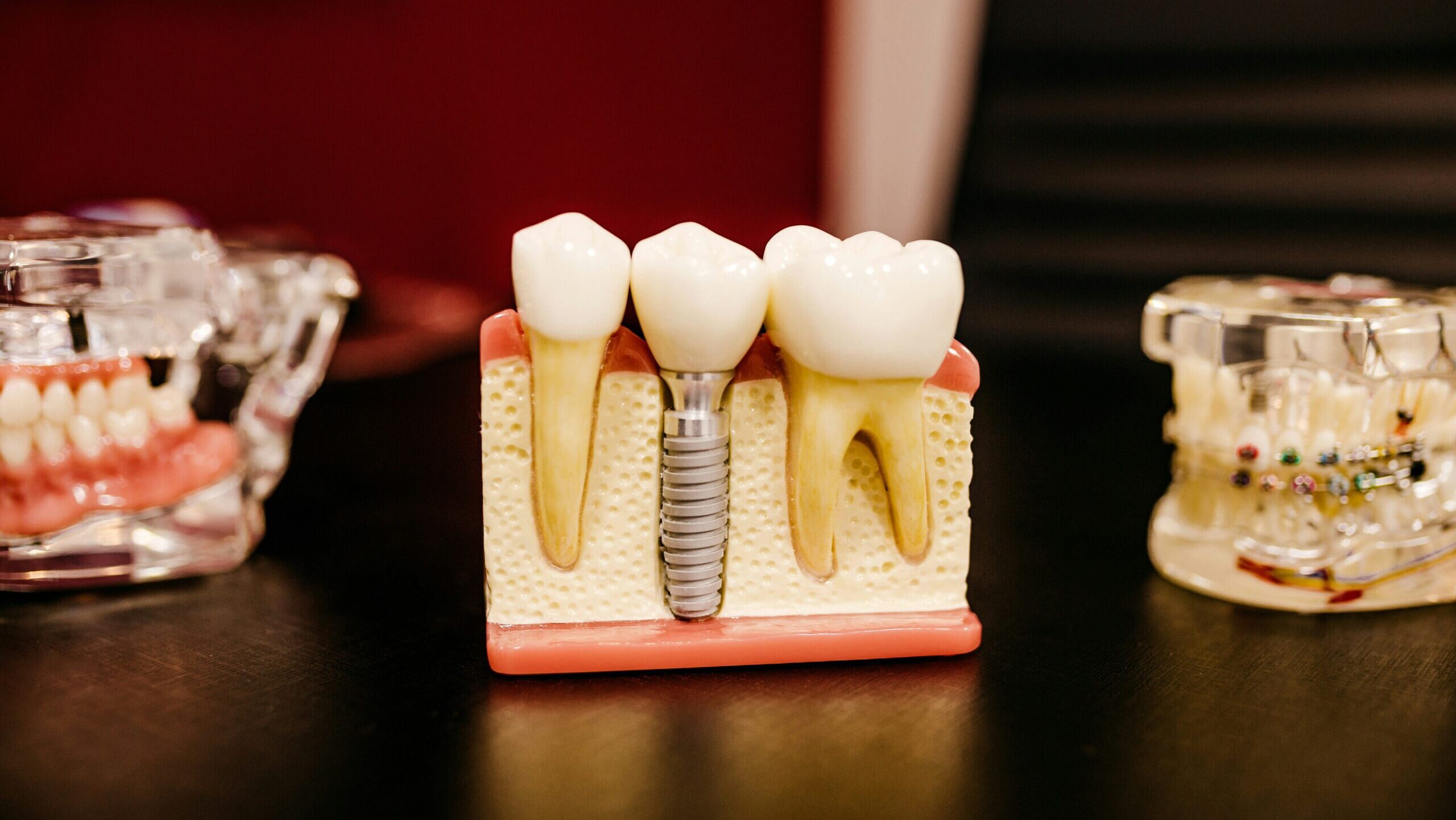 Corona Dental: Todo lo que debes saber